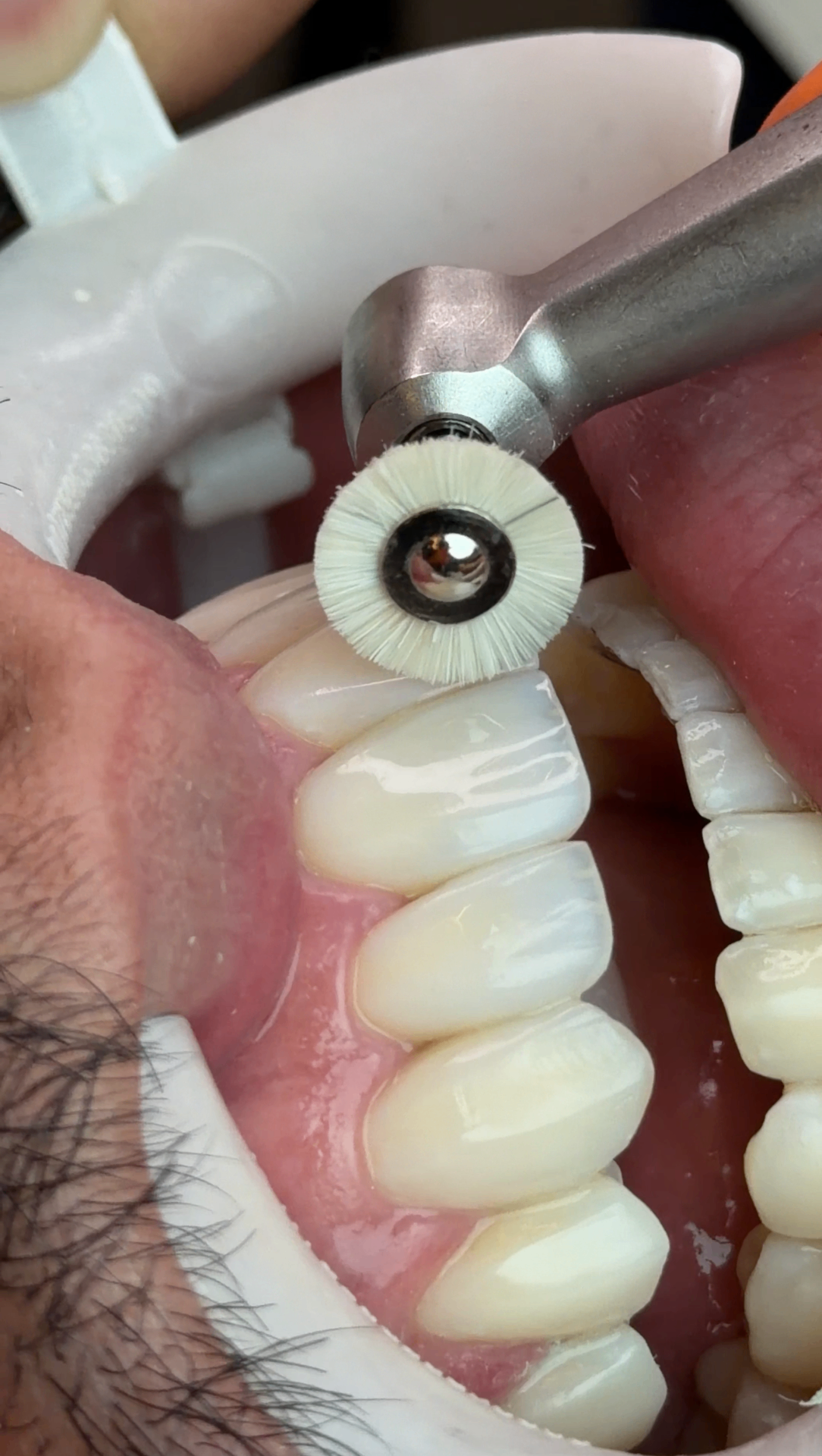 Escovação de brilho no dente